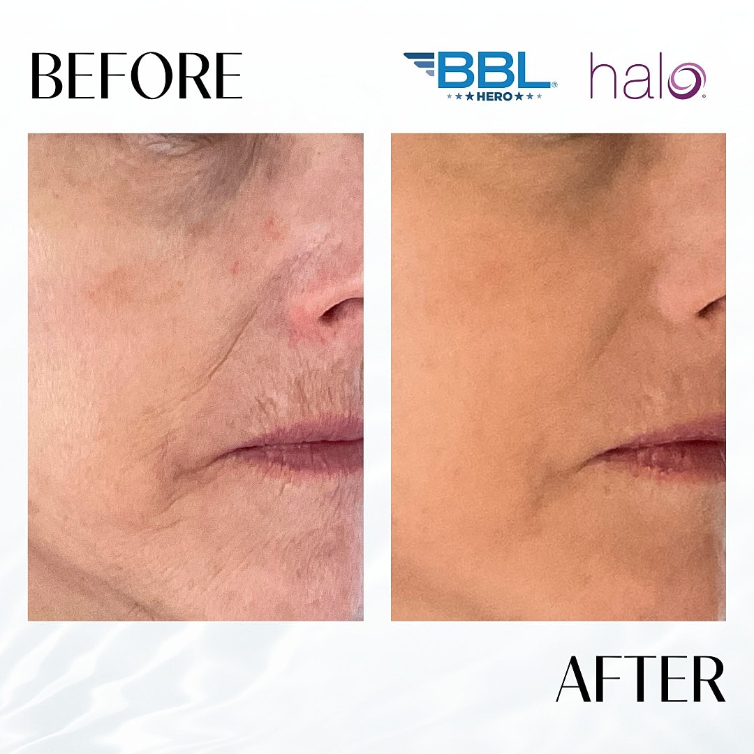 Halo Laser Before & After