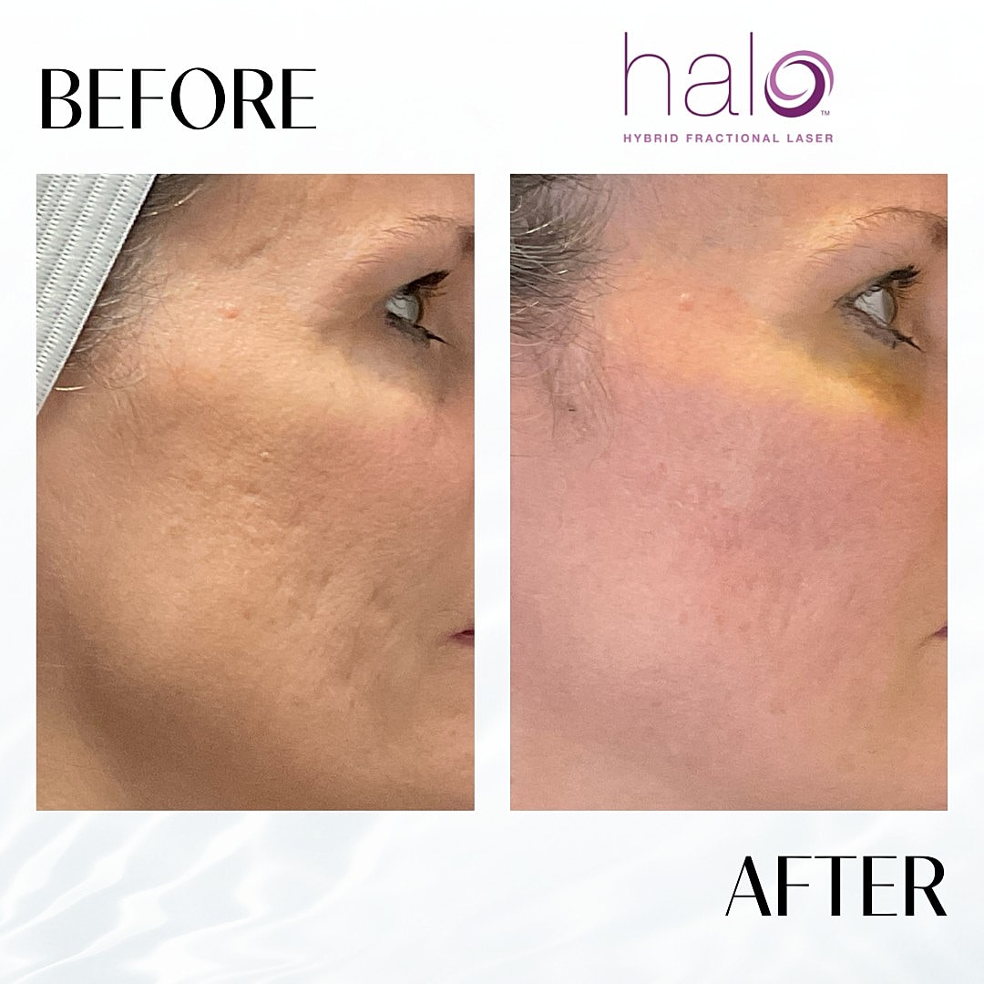 Halo Laser Before & After