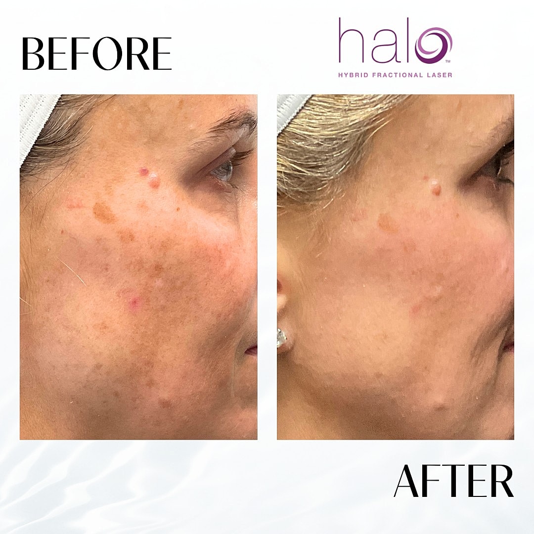 Halo Laser Before & After