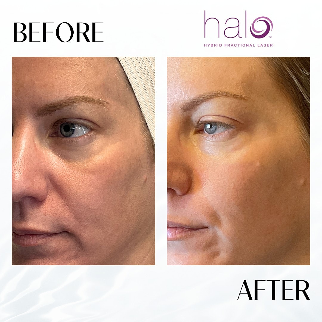 Halo Laser Before & After