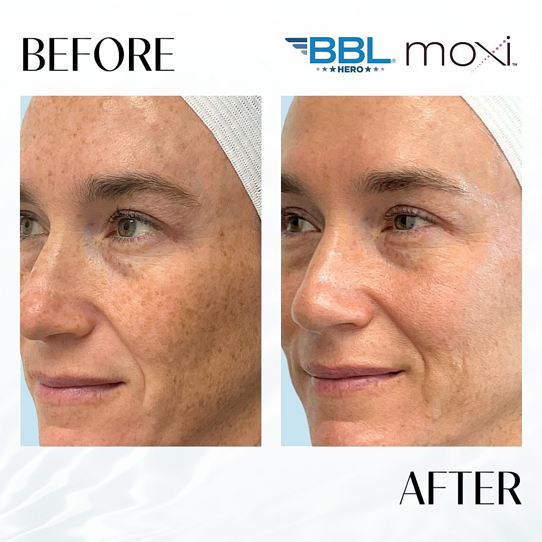Moxi Laser Before & After