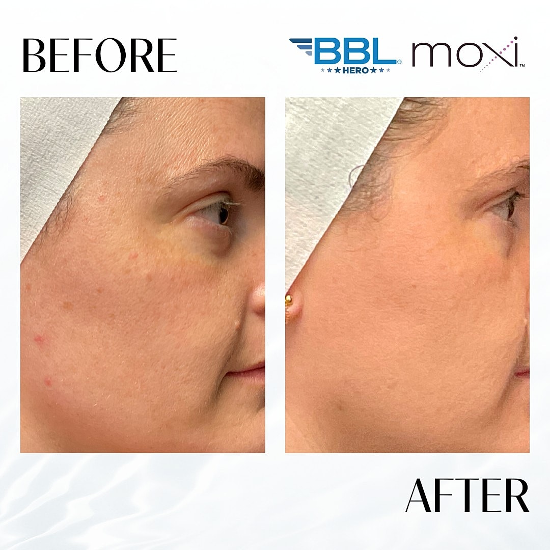 Moxi Laser Before & After
