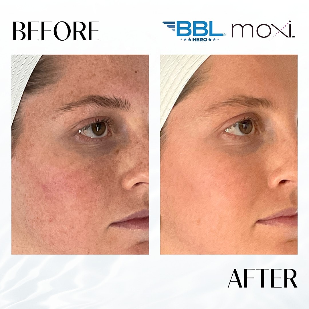 Moxi Laser Before & After
