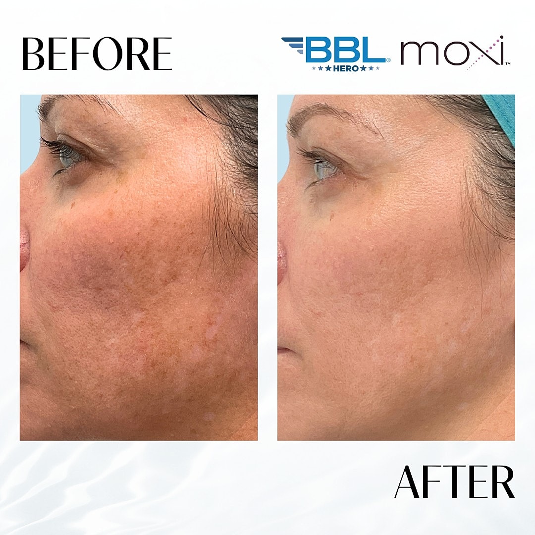 Moxi Laser Before & After