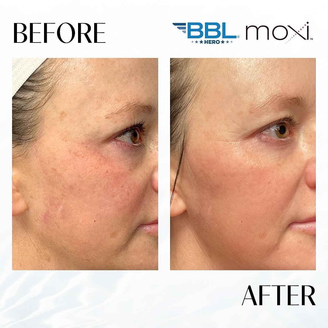 Moxi Laser Before & After