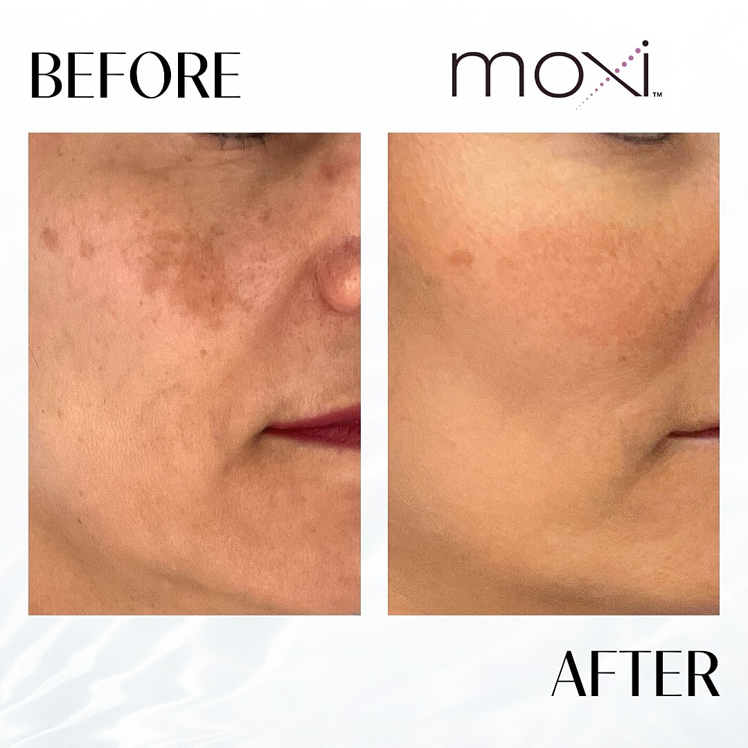 MOXI Laser Before & After