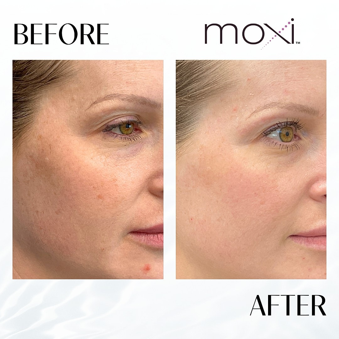 Moxi Laser Before & After