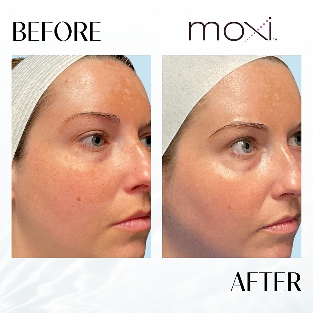 Moxi Laser Before & After
