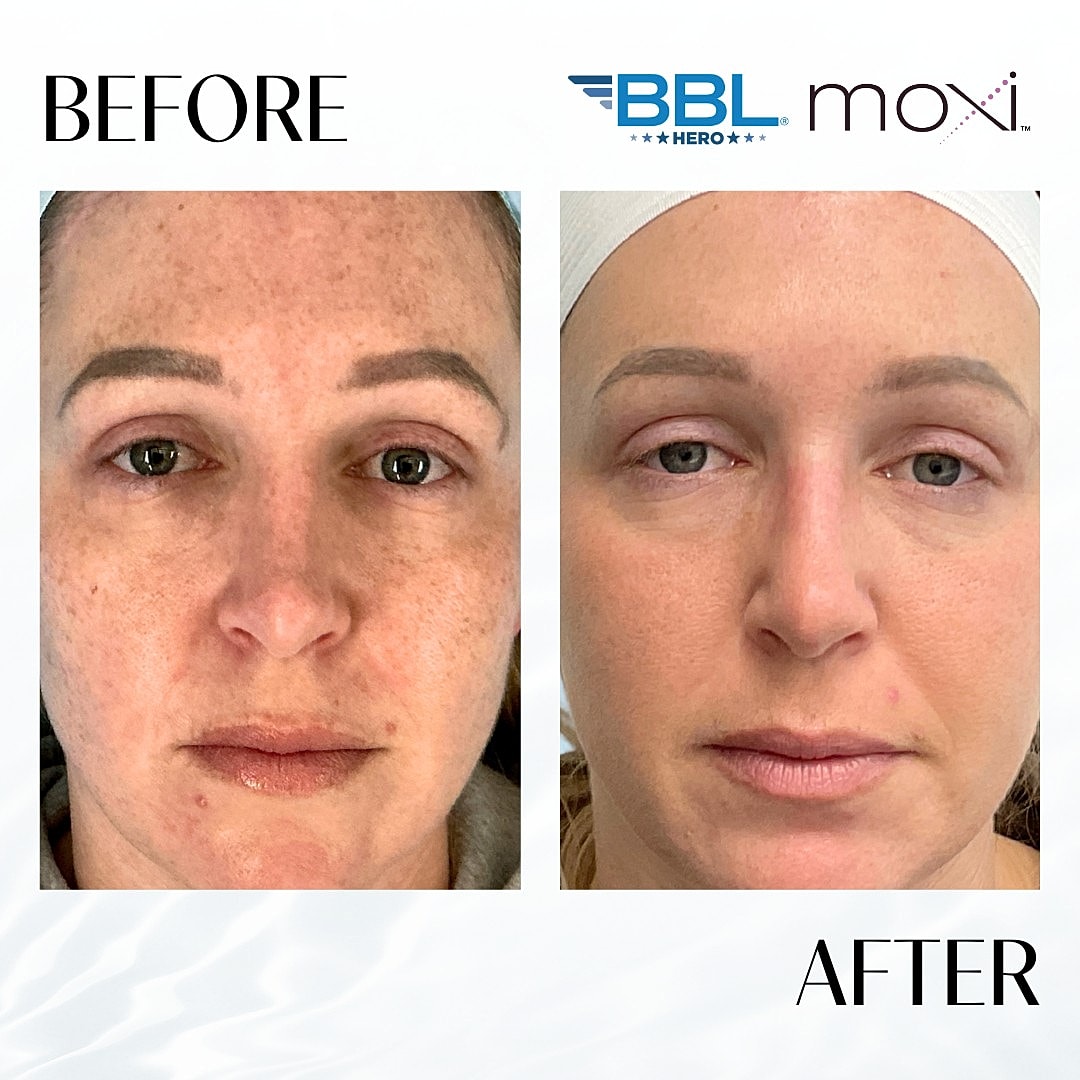 MOXI Laser Before & After