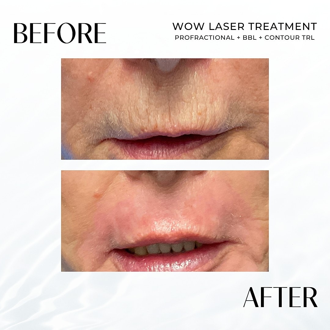 Laser Resurfacing (Wow) Before & After