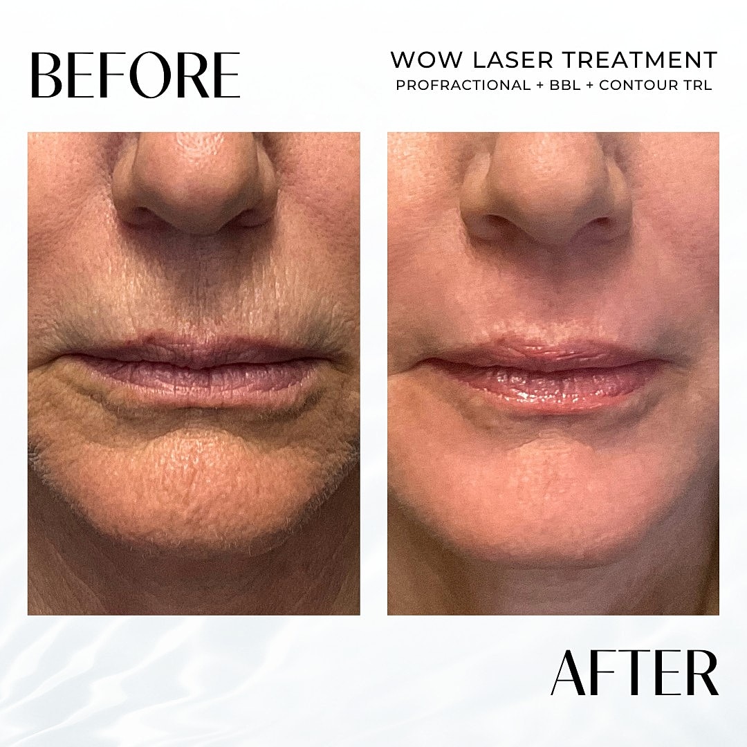 Laser Resurfacing (Wow) Before & After
