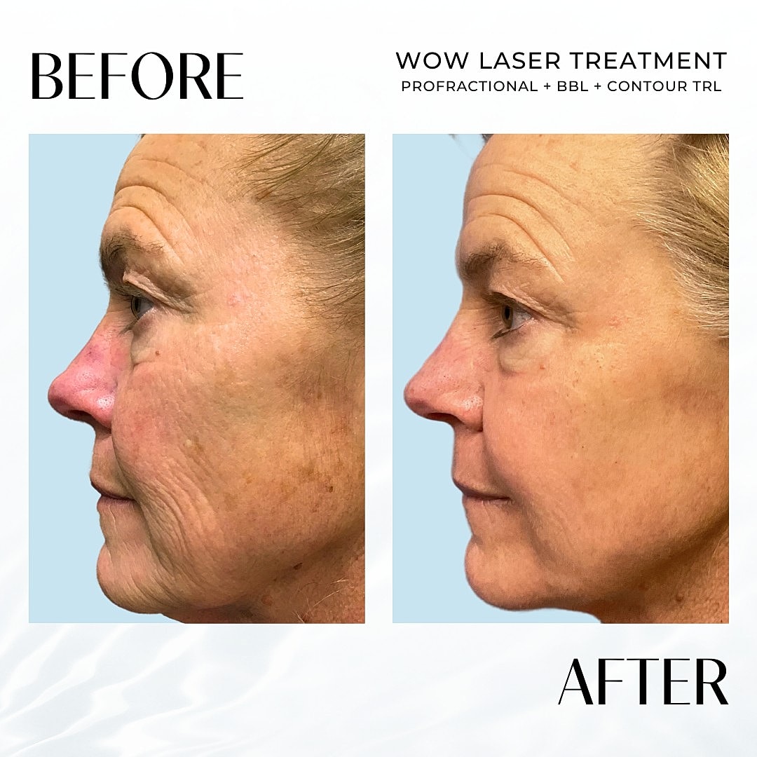 Laser Resurfacing (Wow) Before & After