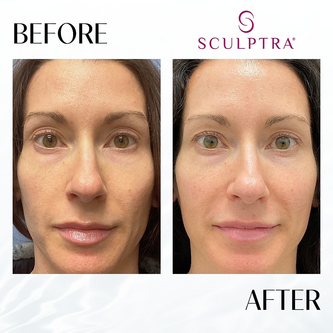 Sculptra Before & After