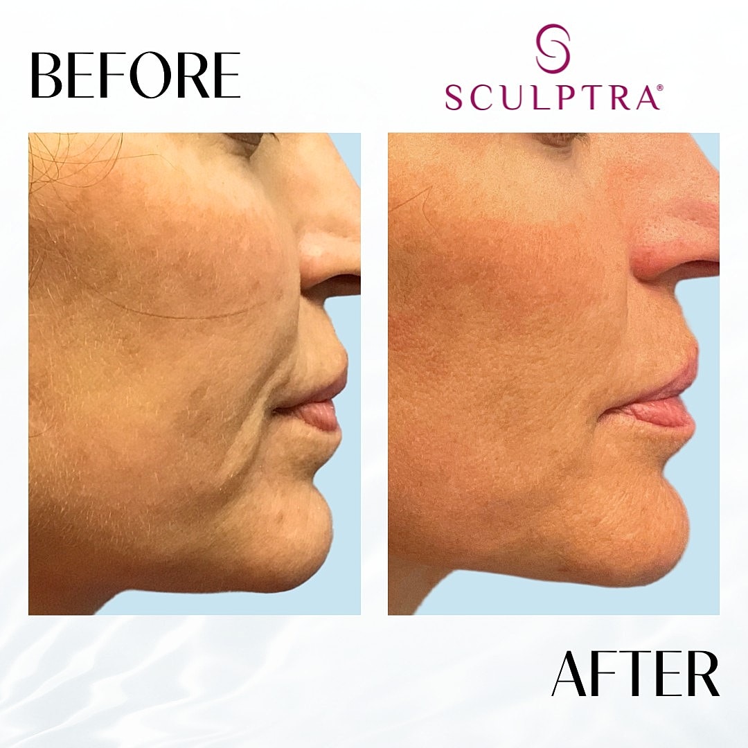 Sculptra Before & After