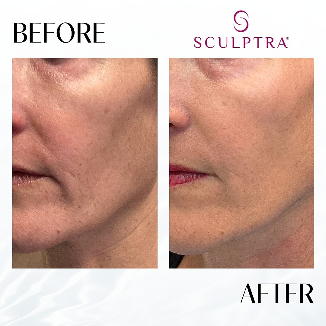 Sculptra Before & After