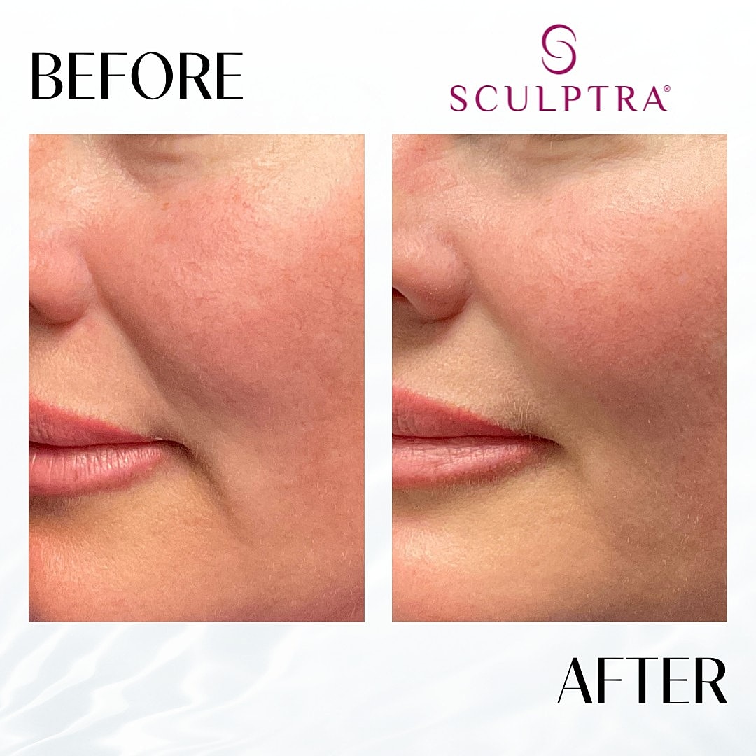 Sculptra Before & After