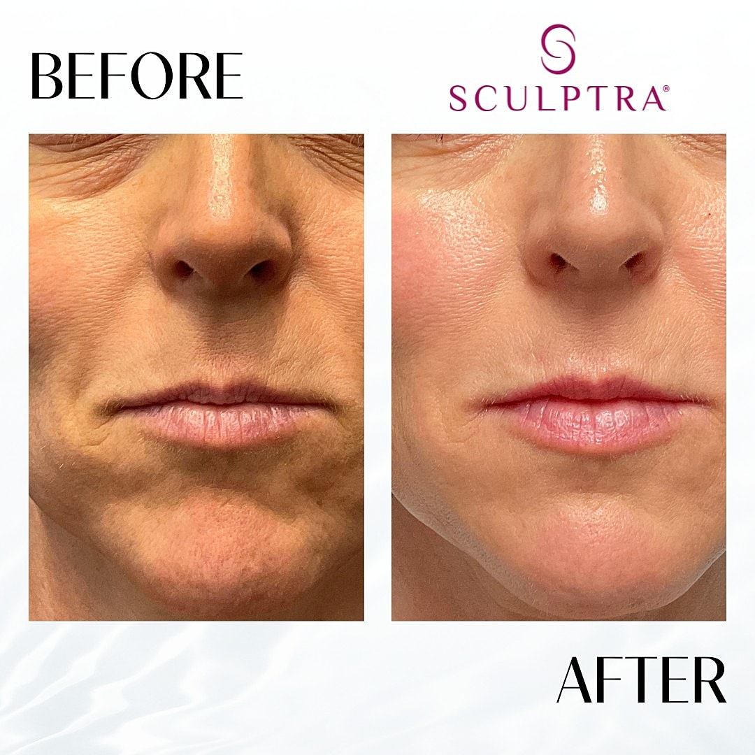 Sculptra Before & After