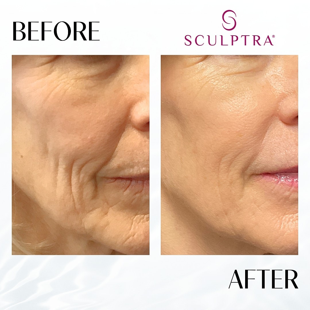 Sculptra Before & After