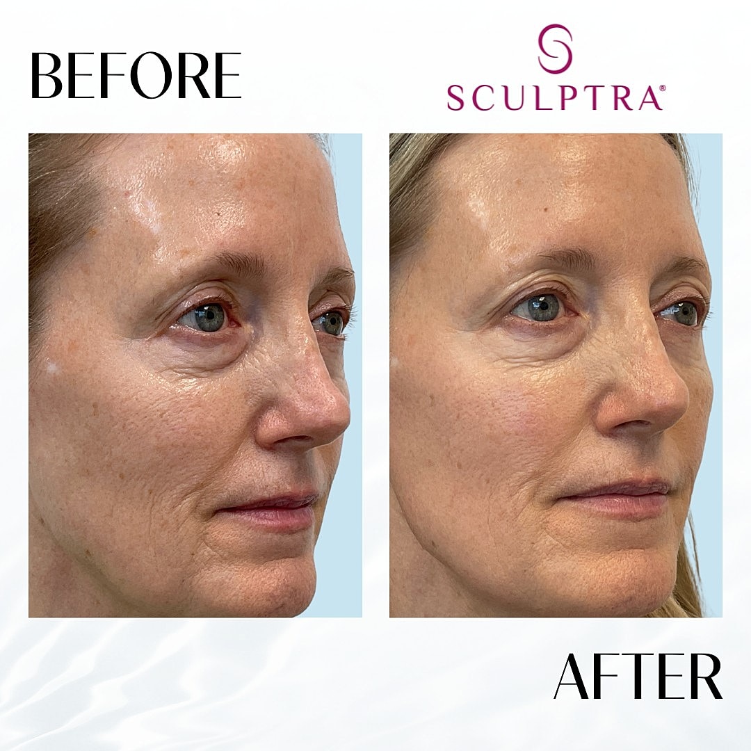 Sculptra Before & After