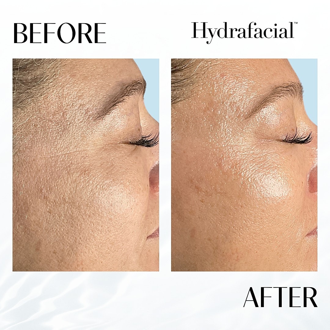 Hydrafacial Before & After