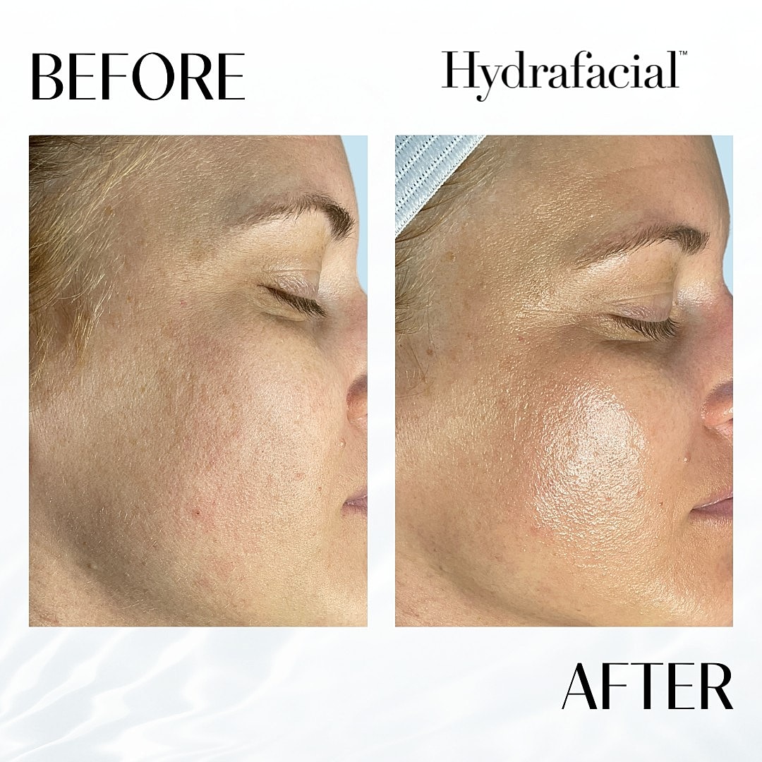 Hydrafacial Before & After