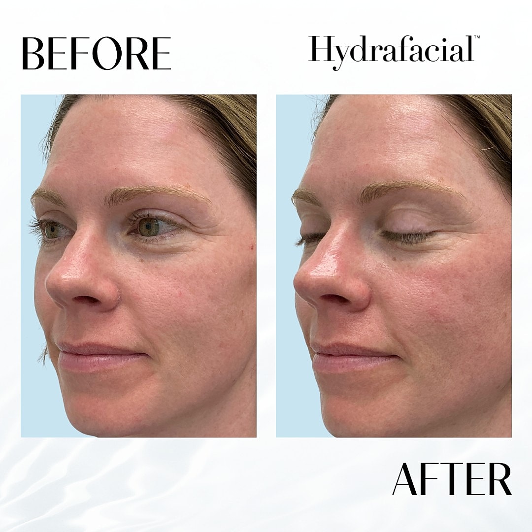 Hydrafacial Before & After