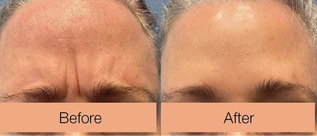 Botox before and after | Denver Med Spa
